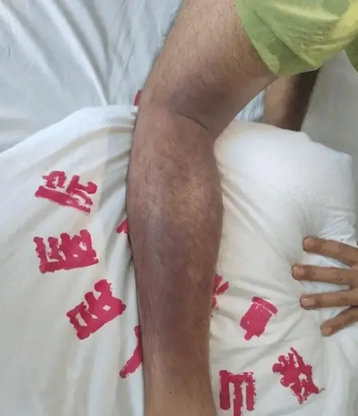 云南男子深山遭3条竹叶青围攻:咬伤12处险些丧命!