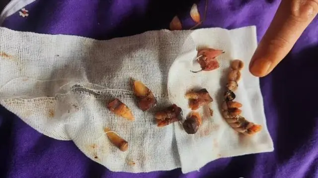 大风追踪|给心梗老人一次拔12颗牙种10颗，宝鸡渭滨区卫健局市监局全面调查处置，将对大团圆口腔医院顶格行政处罚