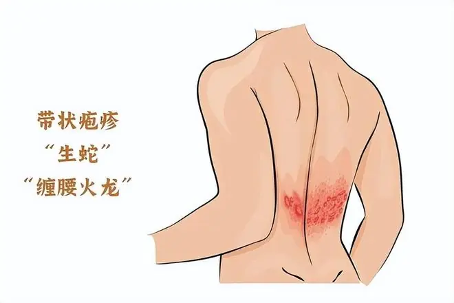 人不会无缘无故患带状疱疹！研究发现：得带状疱疹，多半有4共性